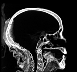 Sagittal view of Ti Ameny Net's head